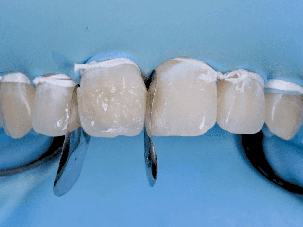 Stratification simplifiée : de la théorie à la pratique