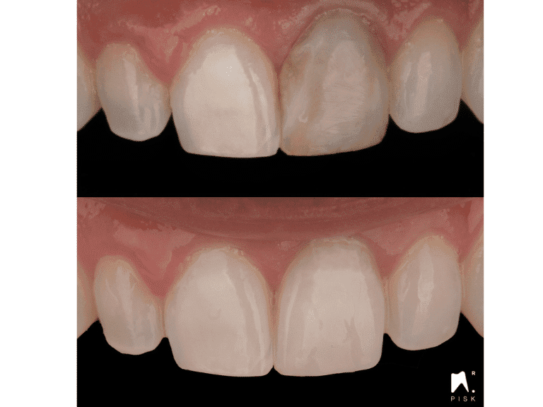 Composites injectés : maîtriser la technique de l’injection de composite fluide
