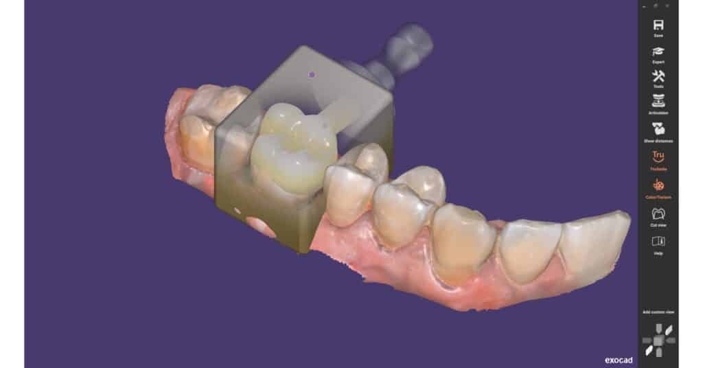 Dentisterie numérique : découverte pratique de la CFAO au cabinet